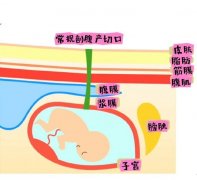 腹膜外剖腹产怎么做的，和正常剖腹产哪个好