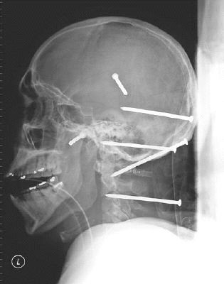 盘点十大起死回生事件 空姐高空坠落奇迹生还