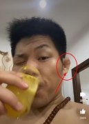 李景亮等UFC里的选手耳朵怎么了，看起来像烧过一样？