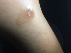烫烟疤到底有多疼？烫烟疤的人心理是不是有问题
