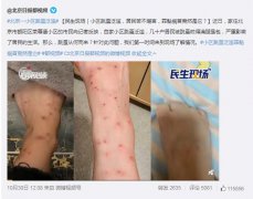 跳蚤咬的包是什么样的图片，跳蚤咬的的疤痕多久能消？