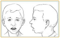 口呼吸面容的经典样子图片，张嘴呼吸变丑能恢复吗？
