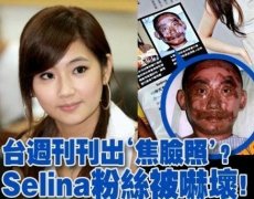 selina任家萱的真实烧伤照片，selina烧伤前后对比图曝光